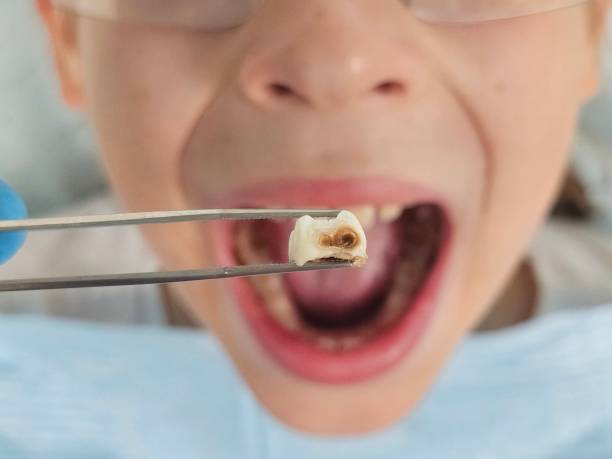 Best Emergency Tooth Extraction in Pittsville, MD